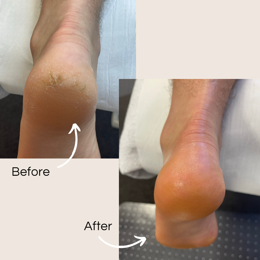How to heal my cracked heels PC Podiatrist Formula